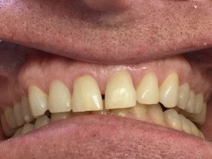 Teeth whitening can be used to brighten your smile