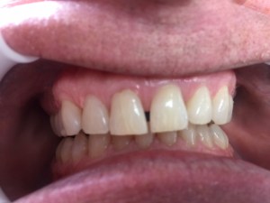 The results of teeth whitening can be pleasing