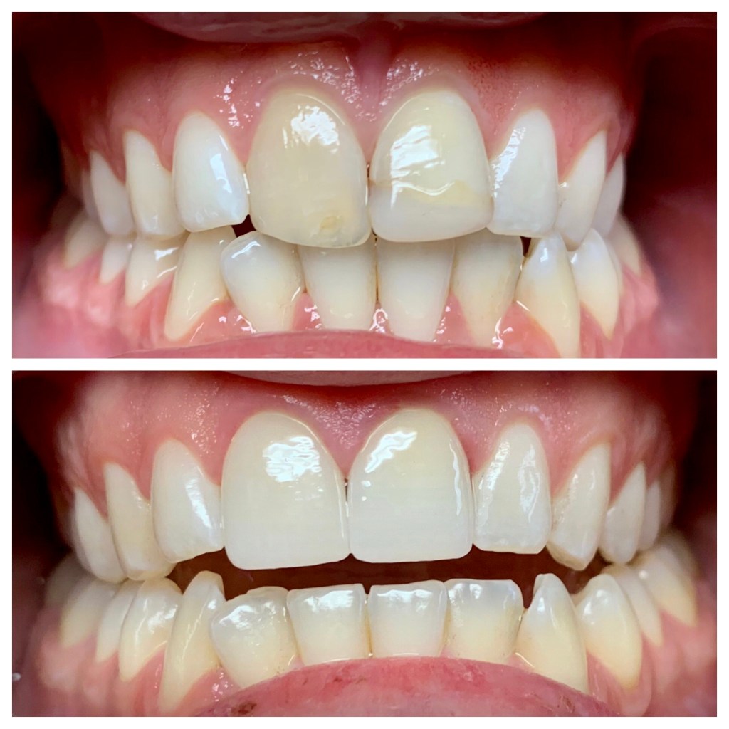 Real denture of a patient