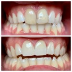Real denture of a patient