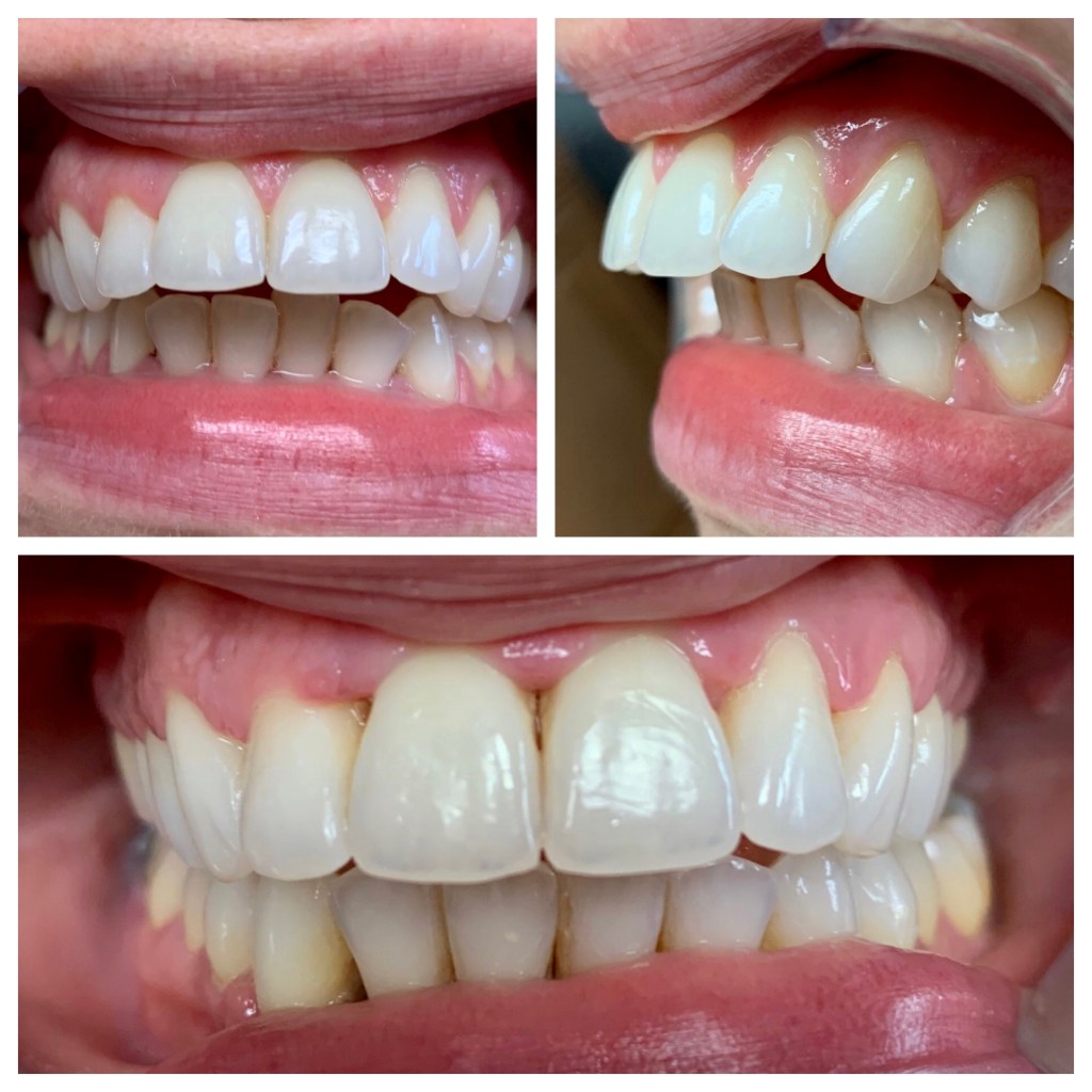 Real denture of a patient