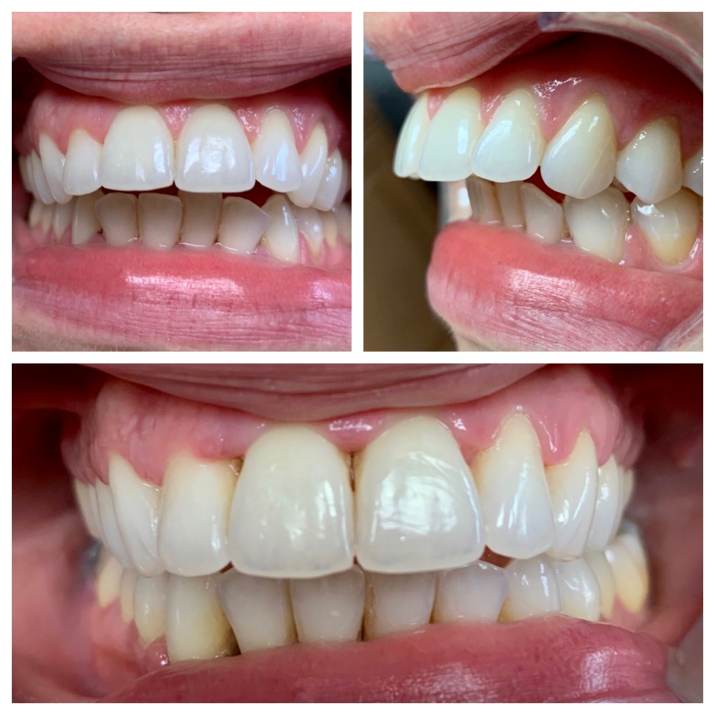 Invisalign Wexford PA, Clear Braces, Straighten Teeth