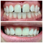 Real denture of a patient