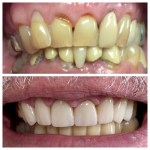 Real denture of a patient