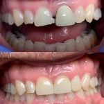 Real denture of a patient