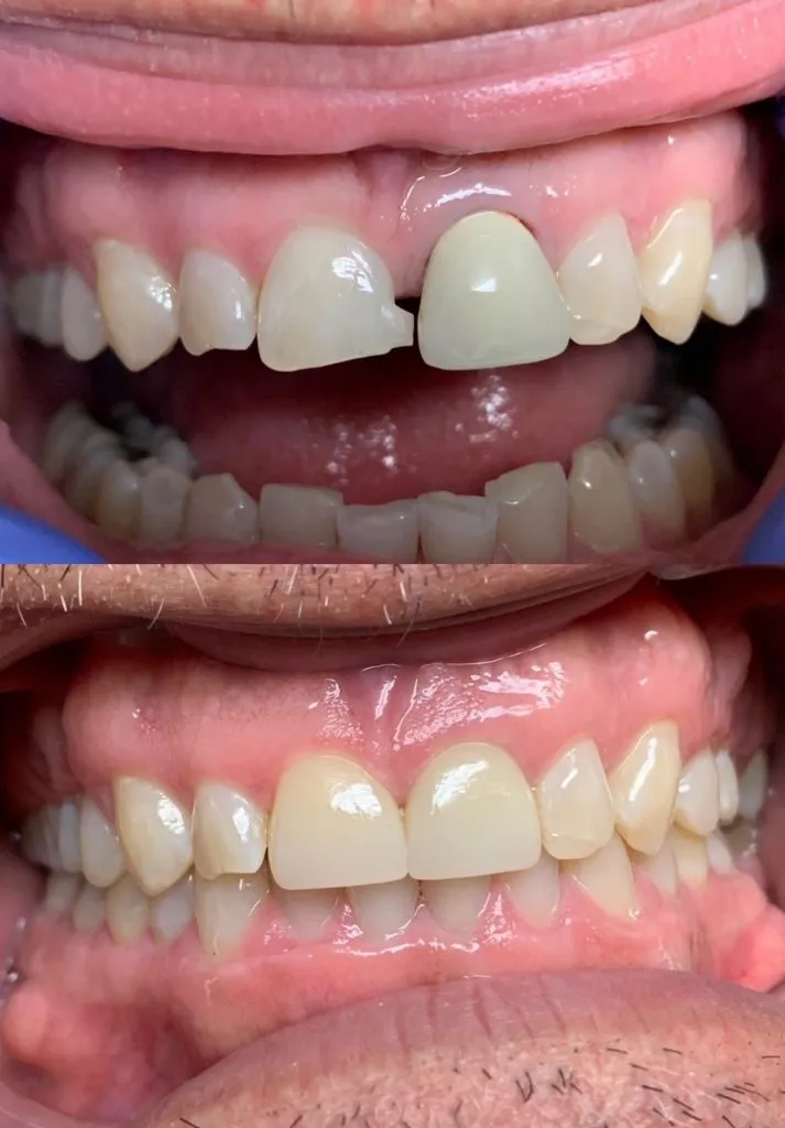 Real denture of a patient
