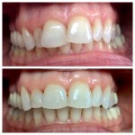 Real denture of a patient