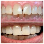 Real denture of a patient