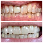 Real denture of a patient