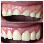 Real denture of a patient